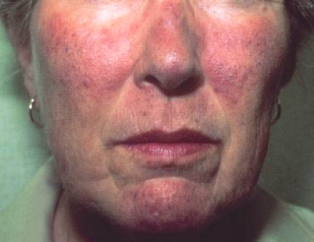 Carcinoid syndrome - Hình ảnh minh họa